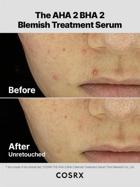 Cosrx The AHA 2 BHA 2 Blemish Treatment Serum